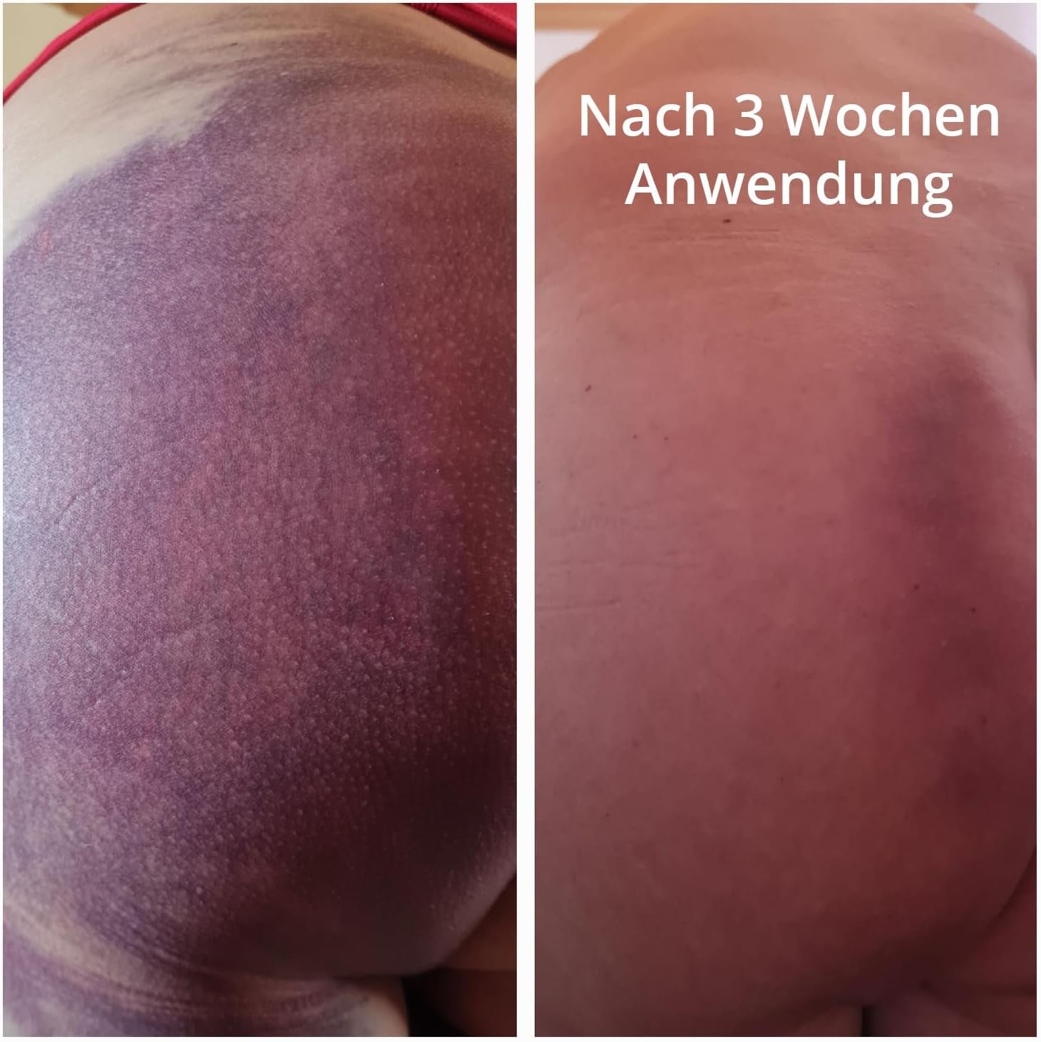 Casida® Hämatom Pflege Öl Repair & Protect - Aromapflegeöl Aus 100% Naturreinen Ölen - Für Die Pflege Von Hämatomen, Blauen Flecken Und Blutergüssen - 50 Ml